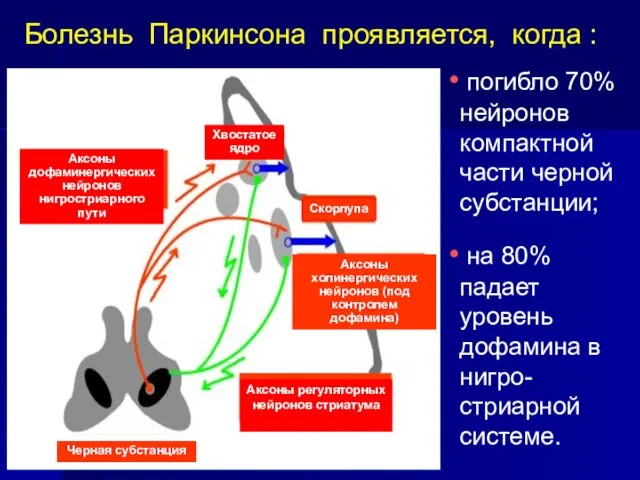 Болезнь Паркинсона проявляется, когда : погибло 70% нейронов компактной части черной