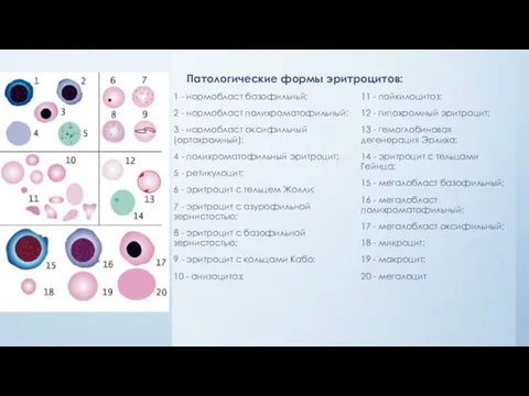 Патологические формы эритроцитов: 1 - нормобласт базофильньй; 2 - нормобласт полихроматофильный;