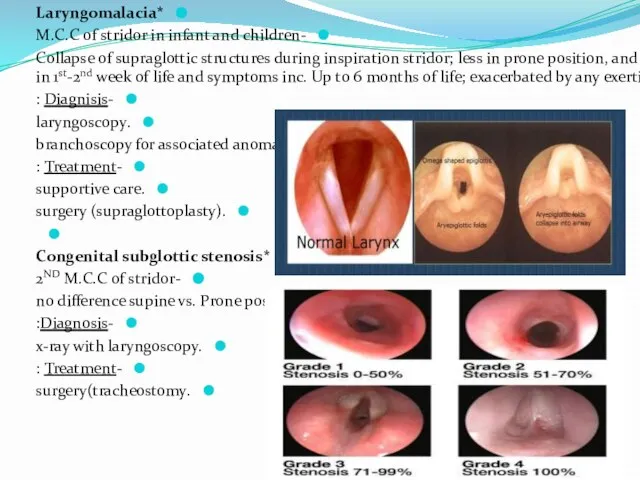 *Laryngomalacia -M.C.C of stridor in infant and children -Collapse of supraglottic