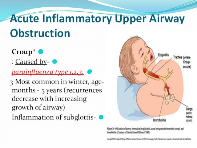 Acute Inflammatory Upper Airway Obstruction *Croup -Caused by : .parainfluenza type