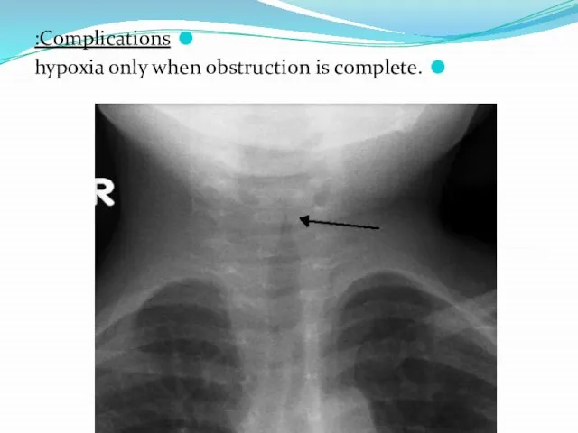 Complications: .hypoxia only when obstruction is complete