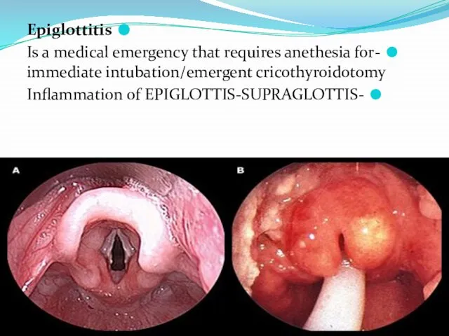 Epiglottitis -Is a medical emergency that requires anethesia for immediate intubation/emergent cricothyroidotomy -Inflammation of EPIGLOTTIS-SUPRAGLOTTIS