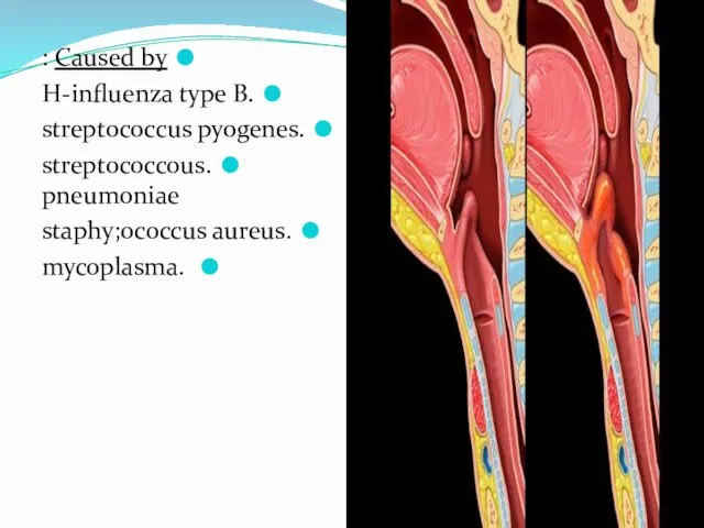 Caused by : .H-influenza type B .streptococcus pyogenes .streptococcous pneumoniae .staphy;ococcus aureus .mycoplasma