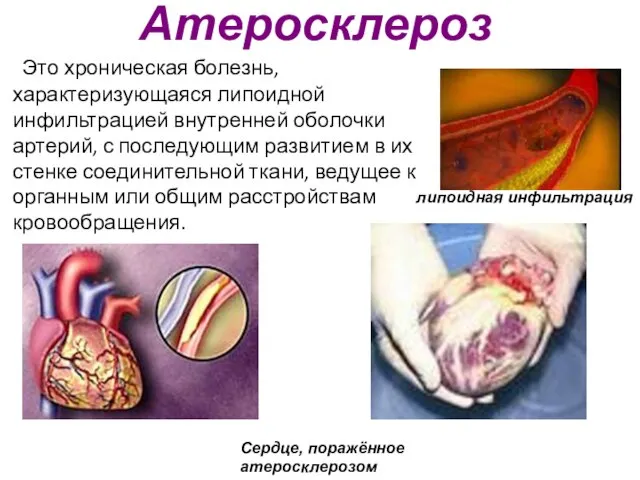 Атеросклероз Это хроническая болезнь, характеризующаяся липоидной инфильтрацией внутренней оболочки артерий, с