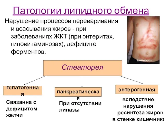 Патологии липидного обмена Нарушение процессов переваривания и всасывания жиров - при