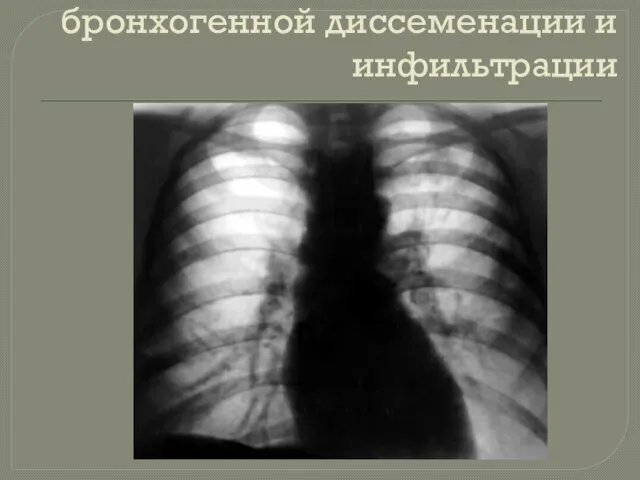 Туберкулёма в стадии бронхогенной диссеменации и инфильтрации