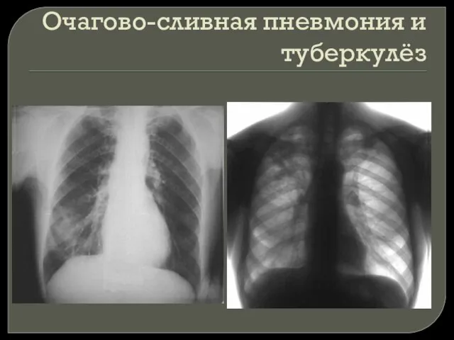 Очагово-сливная пневмония и туберкулёз