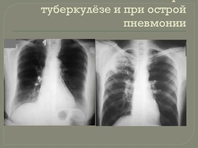 Очаговые тени при туберкулёзе и при острой пневмонии