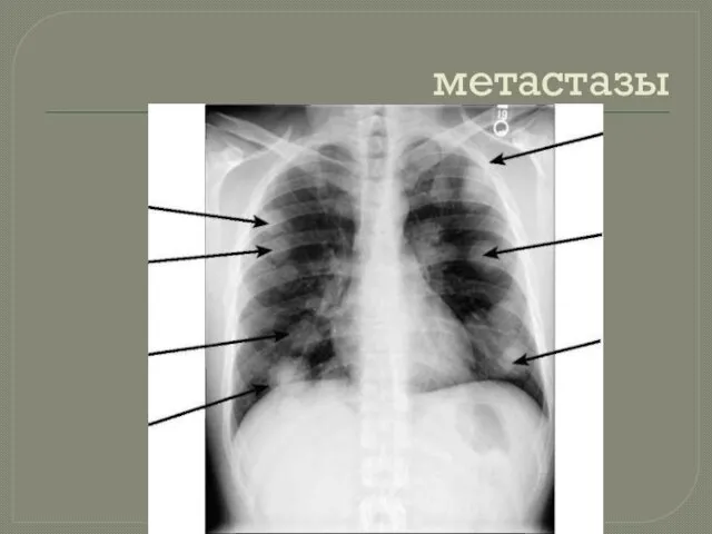 метастазы