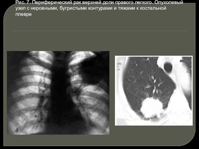 Рис. 7. Периферический рак верхней доли правого легкого. Опухолевый узел с