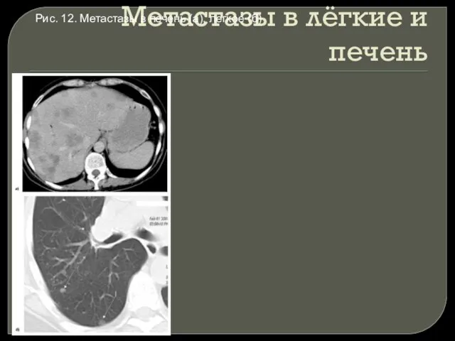 Метастазы в лёгкие и печень Рис. 12. Метастазы в печень (а), легкое (б)