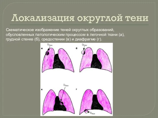 Локализация округлой тени Схематическое изображение теней округлых образований, обусловленных патологическим процессом