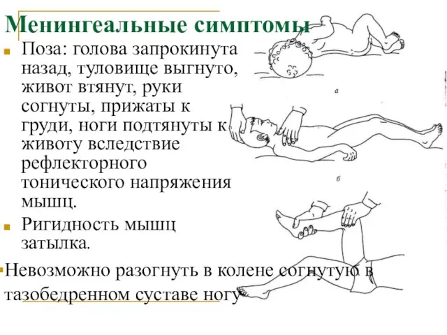 Менингеальные симптомы Поза: голова запрокинута назад, туловище выгнуто, живот втянут, руки