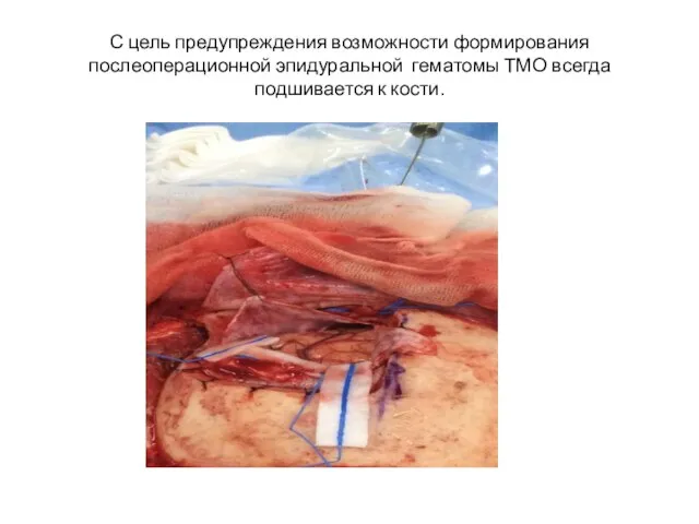С цель предупреждения возможности формирования послеоперационной эпидуральной гематомы ТМО всегда подшивается к кости.