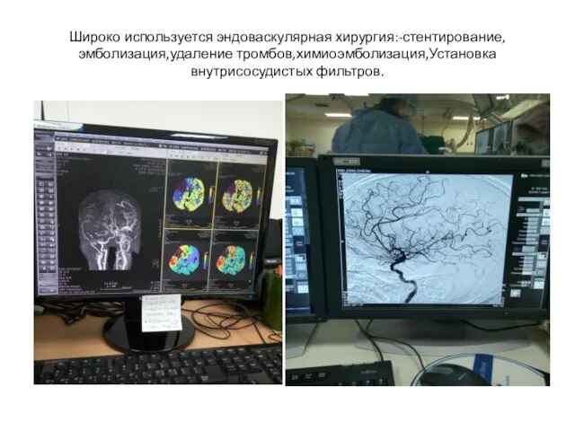 Широко используется эндоваскулярная хирургия:-стентирование,эмболизация,удаление тромбов,химиоэмболизация,Установка внутрисосудистых фильтров.