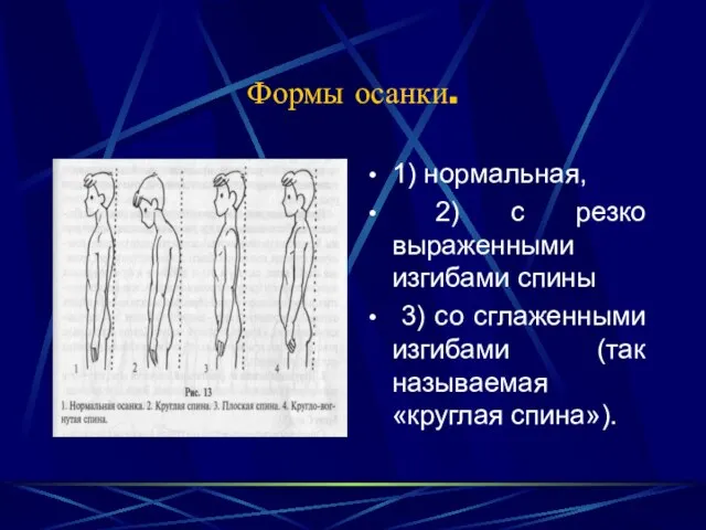 Формы осанки. 1) нормальная, 2) с резко выраженными изгибами спины 3)