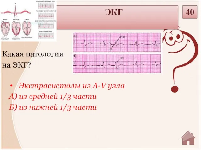 Экстрасистолы из A-V узла А) из средней 1/3 части Б) из