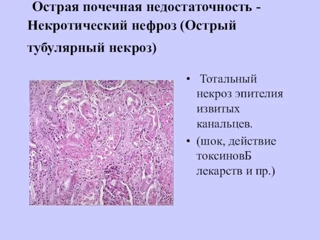 Острая почечная недостаточность - Некротический нефроз (Острый тубулярный некроз) Тотальный некроз