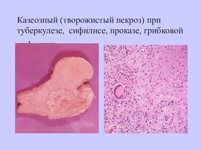 Казеозный (творожистый некроз) при туберкулезе, сифилисе, проказе, грибковой инфекции