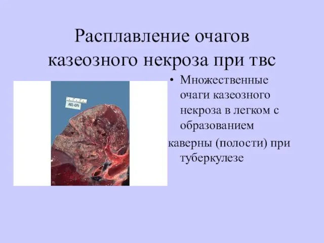 Расплавление очагов казеозного некроза при твс Множественные очаги казеозного некроза в