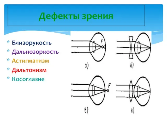 Дефекты зрения Близорукость Дальнозоркость Астигматизм Дальтонизм Косоглазие