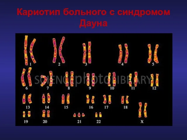 Кариотип больного с синдромом Дауна