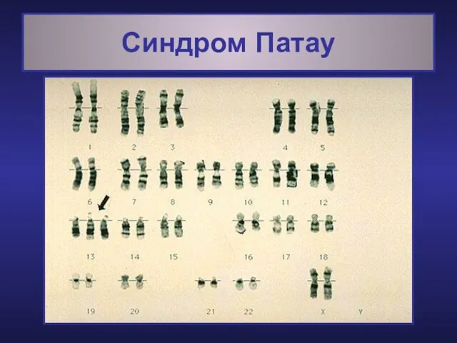 Синдром Патау