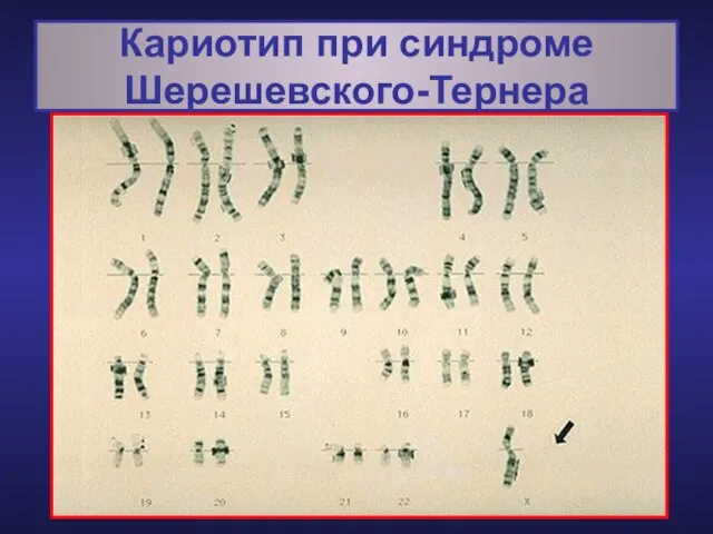 Кариотип при синдроме Шерешевского-Тернера