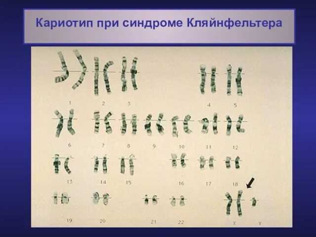 Кариотип при синдроме Кляйнфельтера