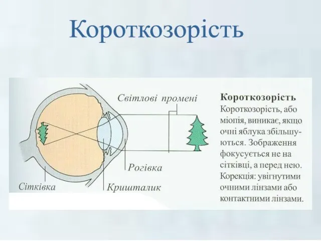 Короткозорість