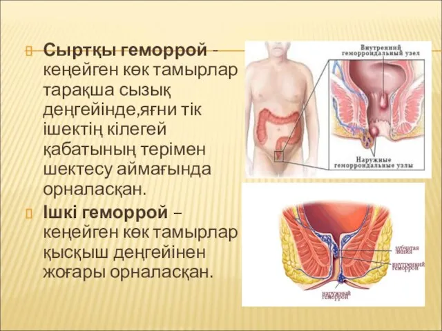 Сыртқы геморрой - кеңейген көк тамырлар тарақша сызық деңгейінде,яғни тік ішектің