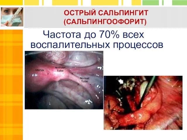 ОСТРЫЙ САЛЬПИНГИТ (САЛЬПИНГООФОРИТ) Частота до 70% всех воспалительных процессов