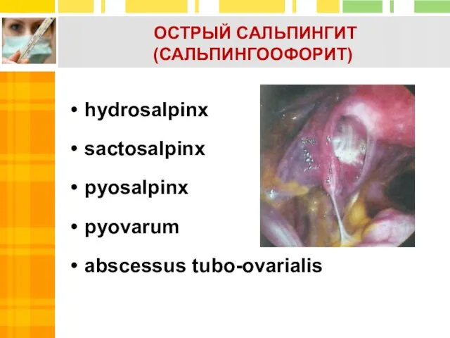 hydrosalpinx sactosalpinx pyosalpinx pyovarum abscessus tubo-ovarialis ОСТРЫЙ САЛЬПИНГИТ (САЛЬПИНГООФОРИТ)