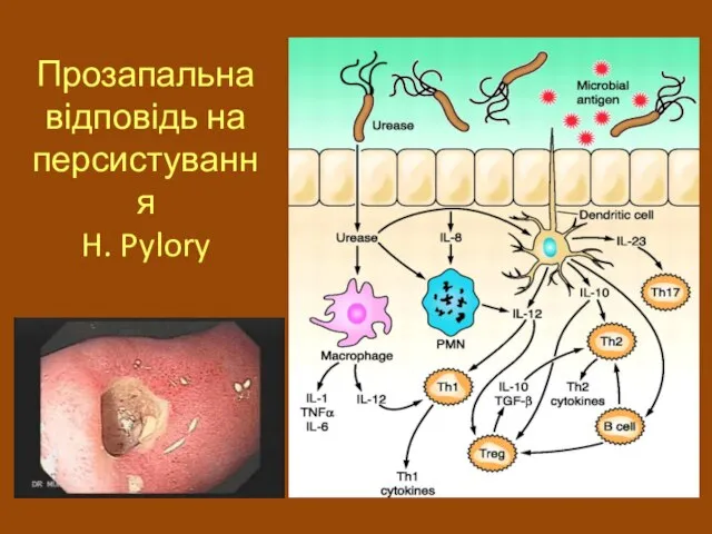 Прозапальна відповідь на персистування H. Pylory