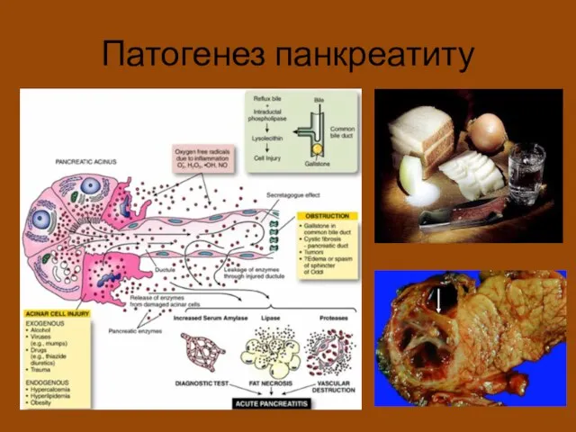 Патогенез панкреатиту