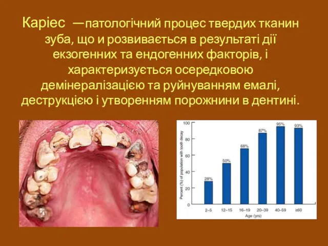 Каріес —патологічний процес твердих тканин зуба, що и розвивається в результаті