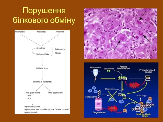 Порушення білкового обміну