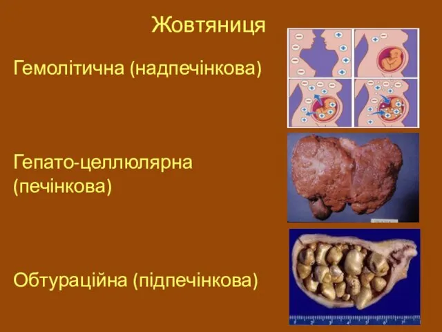 Жовтяниця Гемолітична (надпечінкова) Гепато-целлюлярна (печінкова) Обтураційна (підпечінкова)