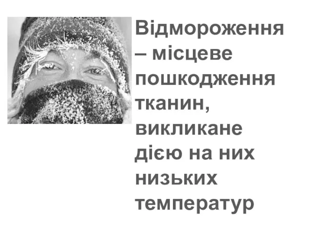 Відмороження – місцеве пошкодження тканин, викликане дією на них низьких температур