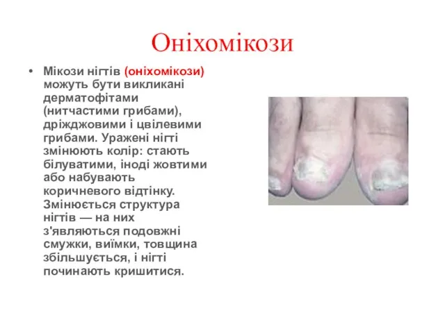 Оніхомікози Мікози нігтів (оніхомікози) можуть бути викликані дерматофітами (нитчастими грибами), дріжджовими