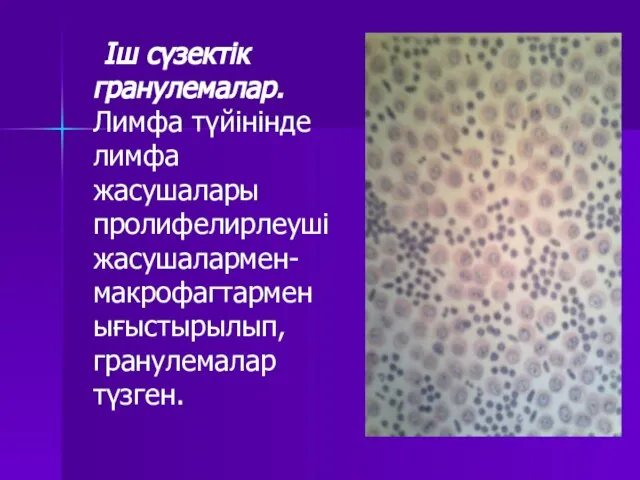 Іш сүзектік гранулемалар. Лимфа түйінінде лимфа жасушалары пролифелирлеуші жасушалармен-макрофагтармен ығыстырылып, гранулемалар түзген.