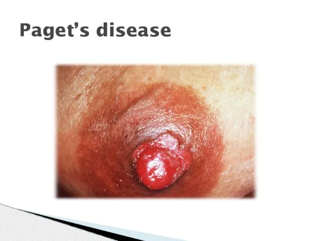 Paget’s disease