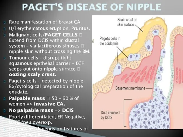 PAGET’S DISEASE OF NIPPLE Rare manifestation of breast CA. U/l erythematous