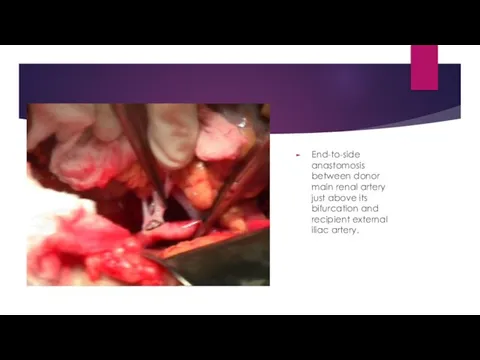 End-to-side anastomosis between donor main renal artery just above its bifurcation and recipient external iliac artery.