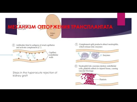 Steps in the hyperacute rejection of kidney graft МЕХАНИЗМ ОТТОРЖЕНИЯ ТРАНСПЛАНТАТА