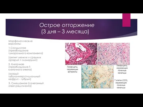 Острое отторжение (3 дня – 3 месяца) Морфологические варианты: 1.Сосудистое (преобладание