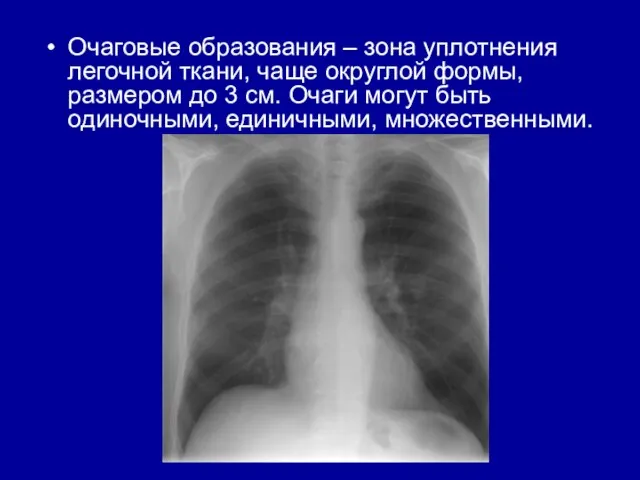 Очаговые образования – зона уплотнения легочной ткани, чаще округлой формы, размером