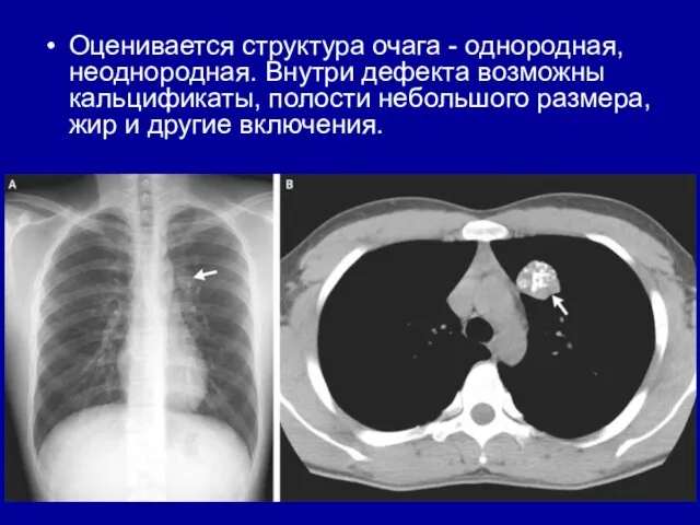 Оценивается структура очага - однородная, неоднородная. Внутри дефекта возможны кальцификаты, полости