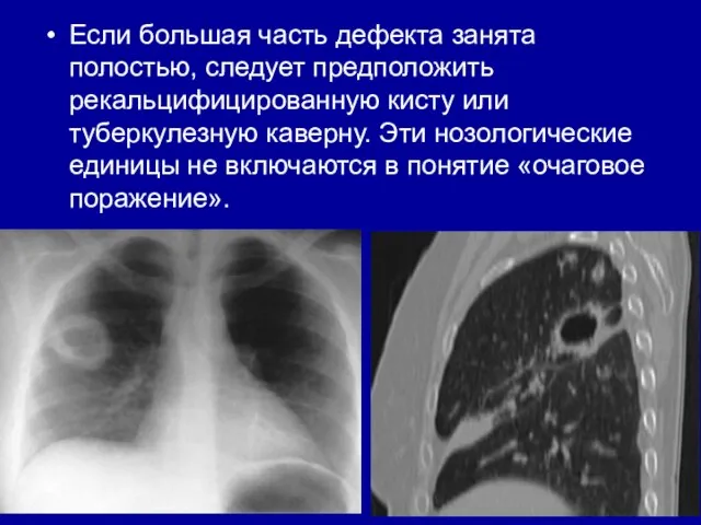 Если большая часть дефекта занята полостью, следует предположить рекальцифицированную кисту или