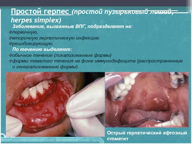 Простой герпес (простой пузырьковый лишай, herpes simplex) Острый герпетический афтозный стоматит